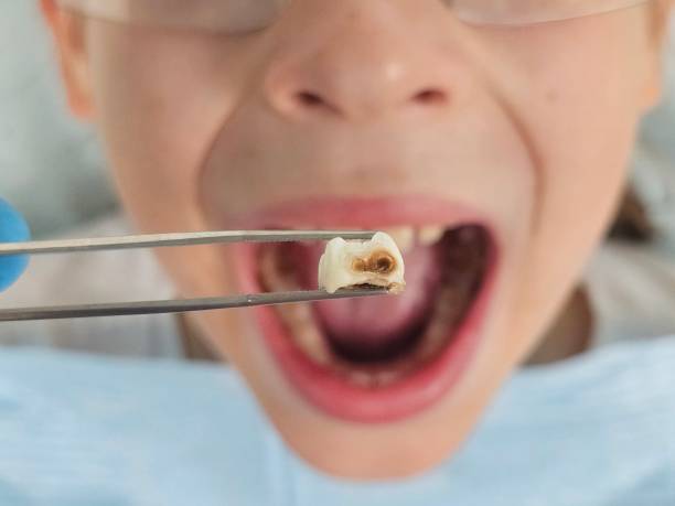 Best Broken or Cracked Tooth Emergency Dentist in Lopezville, TX